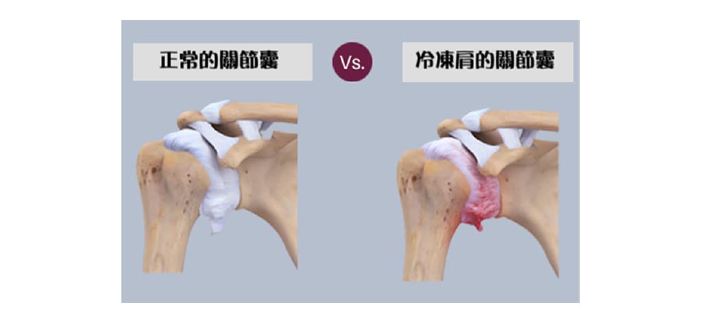 frozen-shoulder-causes-symptoms-treatment-1